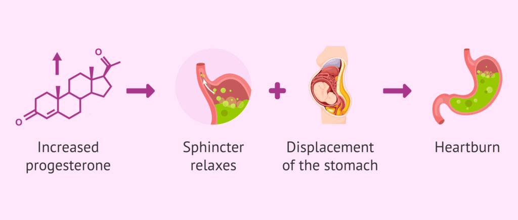 An illustration depicting the discomfort of heartburn and acid reflux, highlighting the impact of acidity on digestive health.